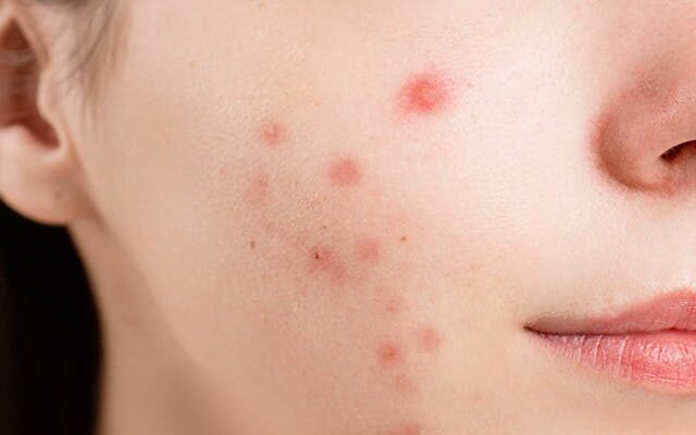 Woman with papule acne on face.