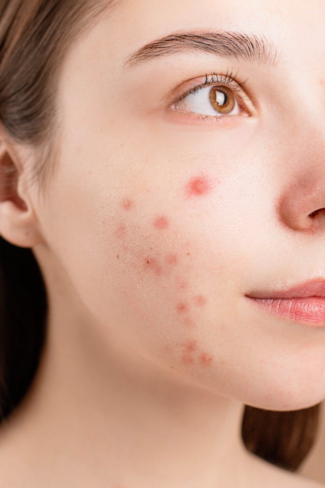 Woman with papule acne on face.